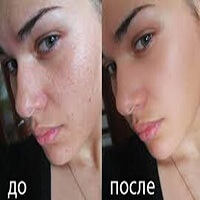 Маска-бандаж