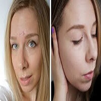 Маска-бандаж